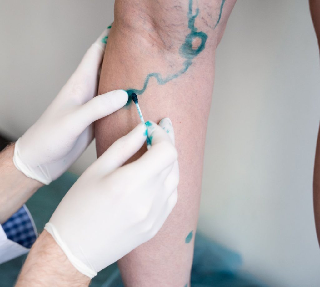 Interventional radiologist in Hazara performing a vascular procedure to treat blood vessel conditions