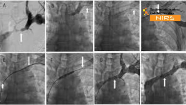 Central Venoplasty in Peshawar performed by experienced vascular surgeons in Peshawar, using advanced imaging and catheter-based techniques to open blocked central veins and improve blood circulation for patients with venous obstruction.