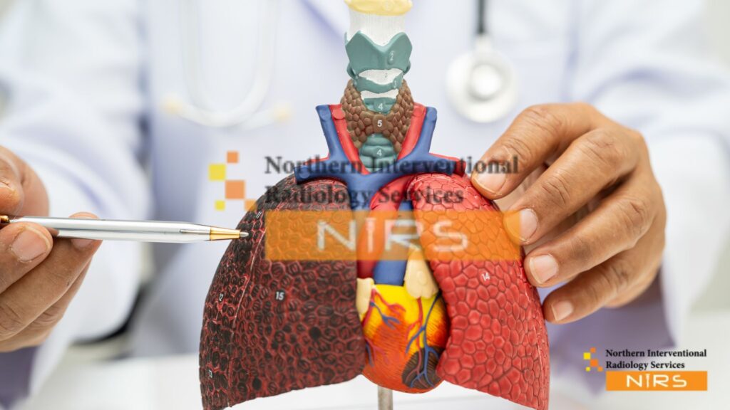 liver cancer treatment with interventional radiology at NIRS Pakistan, showcasing expert radiologists performing TACE (Transarterial Chemoembolization) and Radiofrequency Ablation (RFA) procedures. Using advanced imaging and catheter-based technology, NIRS offers targeted tumor therapy that minimizes side effects and maximizes recovery.