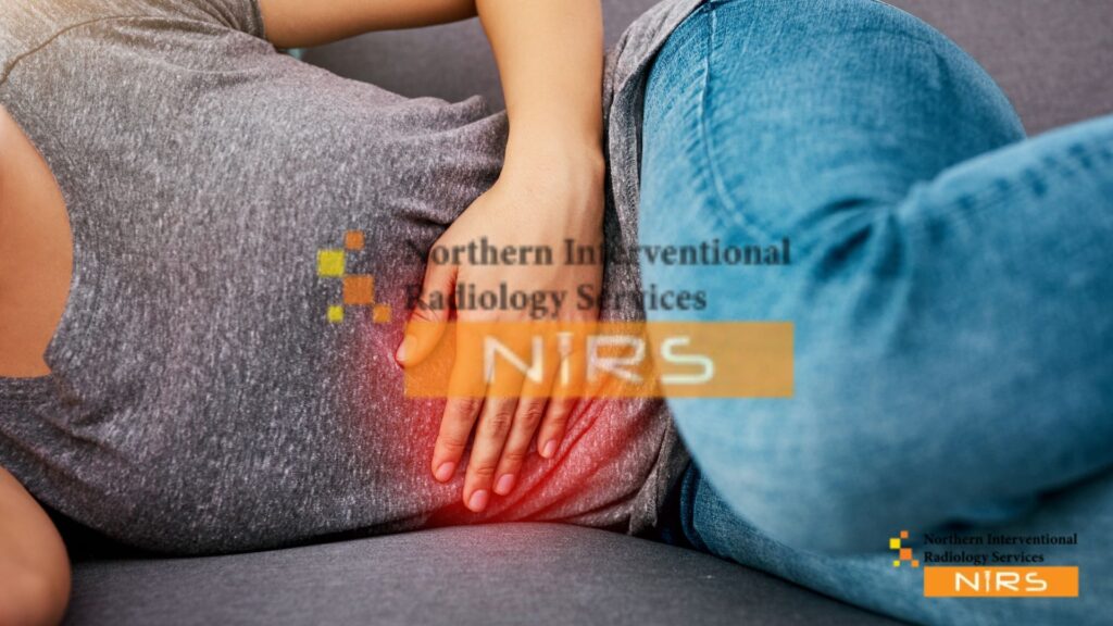 Interventional radiology procedure treating uterine fibroids and pelvic pain also provide other disease solution at nirs