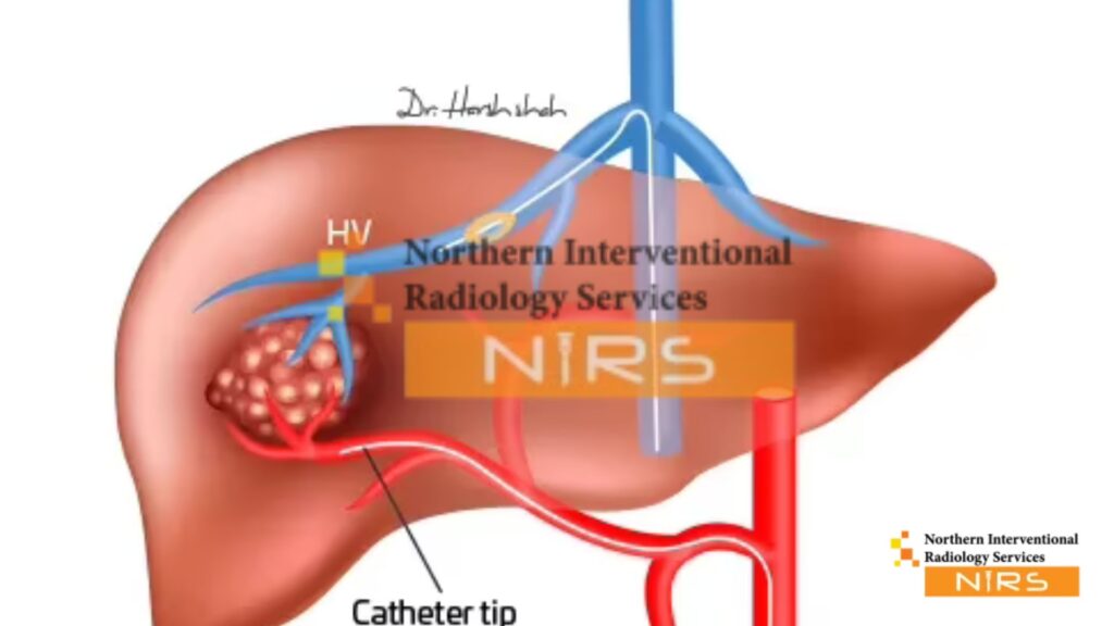 The TACE chemo procedure at NIRS delivers targeted chemotherapy directly to liver tumors using advanced catheter-based techniques for maximum precision and minimal side effects.