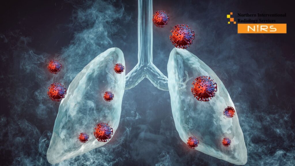 A specialist at NIRS Multan performing an advanced ultrasound-guided lung biopsy using high-resolution imaging technology to collect accurate lung tissue samples safely. The procedure is conducted in a modern clinical environment designed to ensure patient comfort, precision, and expert diagnostic care