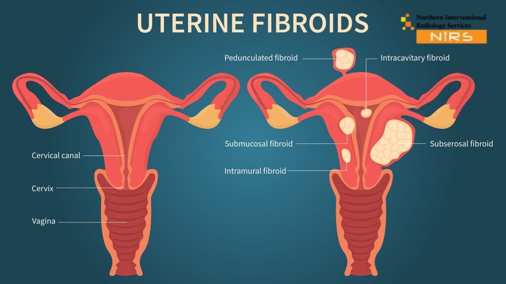Best uterine fibroids treatment in Peshawar at NIRS Pakistan using advanced interventional radiology.
