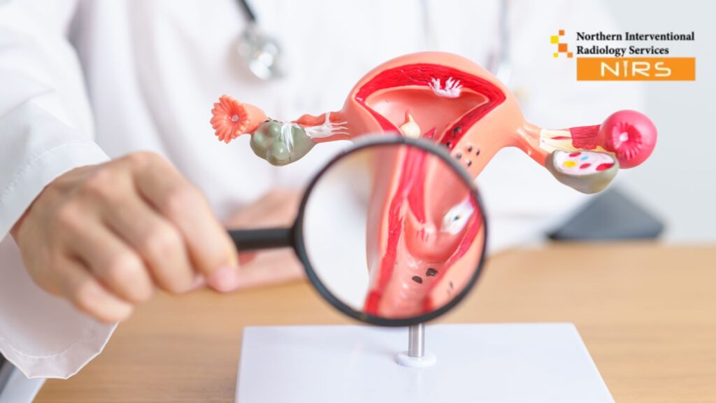 Uterine fibroids treatment in Multan provided by NIRS experts using advanced, minimally invasive interventional radiology procedures designed for safe, effective, and uterus-preserving care, supported by high-resolution imaging and experienced specialists to ensure the best outcomes for women suffering from fibroid pain, heavy bleeding, or fertility-related complications.