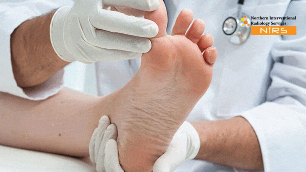 Advanced Diabetic Foot Angioplasty at NIRS Pakistan using interventional radiology for diabetic limb salvage