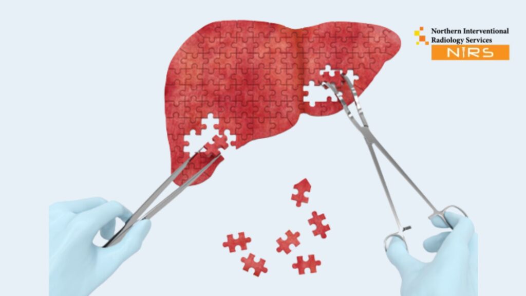 Advanced Liver Cancer Treatment Using IR Interventional Radiology at NIRS Northern Interventional Radiology Services Pakistan