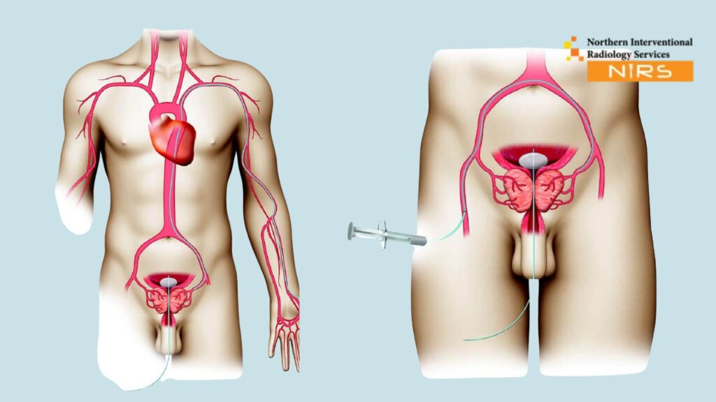 Advanced Prostate Artery Embolization PAE Treatment in Pakistan at NIRS Northern Interventional Radiology Services