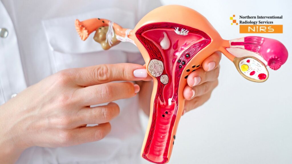 Advanced Uterine Fibroid Treatment in Pakistan at NIRS Northern Interventional Radiology Services Minimally Invasive