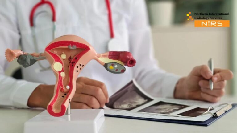 Advanced Uterine Fibroids Treatment in Kahuta Rawalpindi at NIRS – expert UFE, interventional radiology, women’s health care services