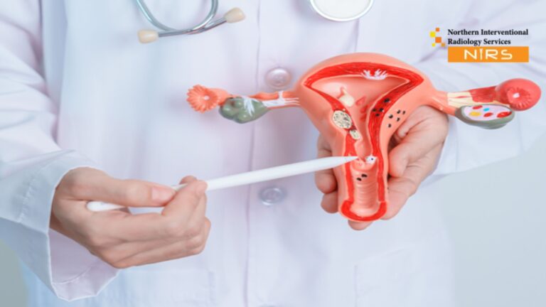 Advanced Uterine Fibroids Treatment in Taxila Rawalpindi by NIRS expert interventional radiology team