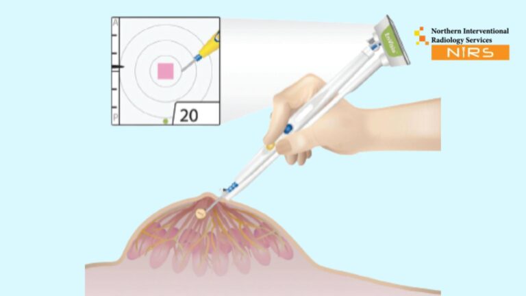 Best Breast Tumor Marker Clip Placement in Millat Town Faisalabad at NIRS – Advanced interventional radiology and minimally invasive breast care