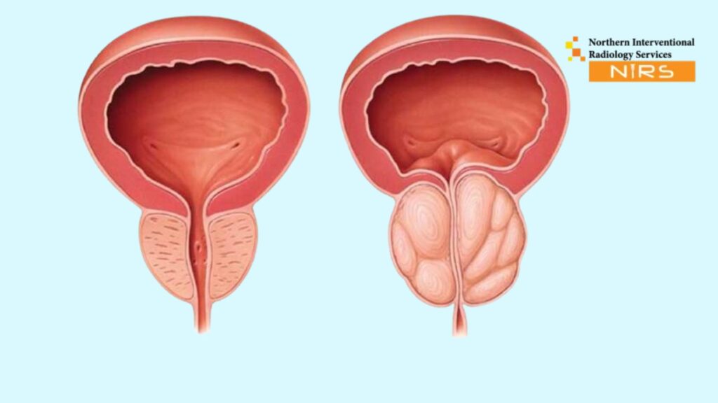 Best Treatment for Enlarged Prostate (BPH) Without Surgery in Pakistan at NIRS Northern Interventional Radiology Services