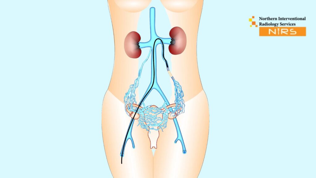 Ovarian Vein Embolization treatment at NIRS Pakistan for pelvic congestion syndrome using advanced interventional radiology
