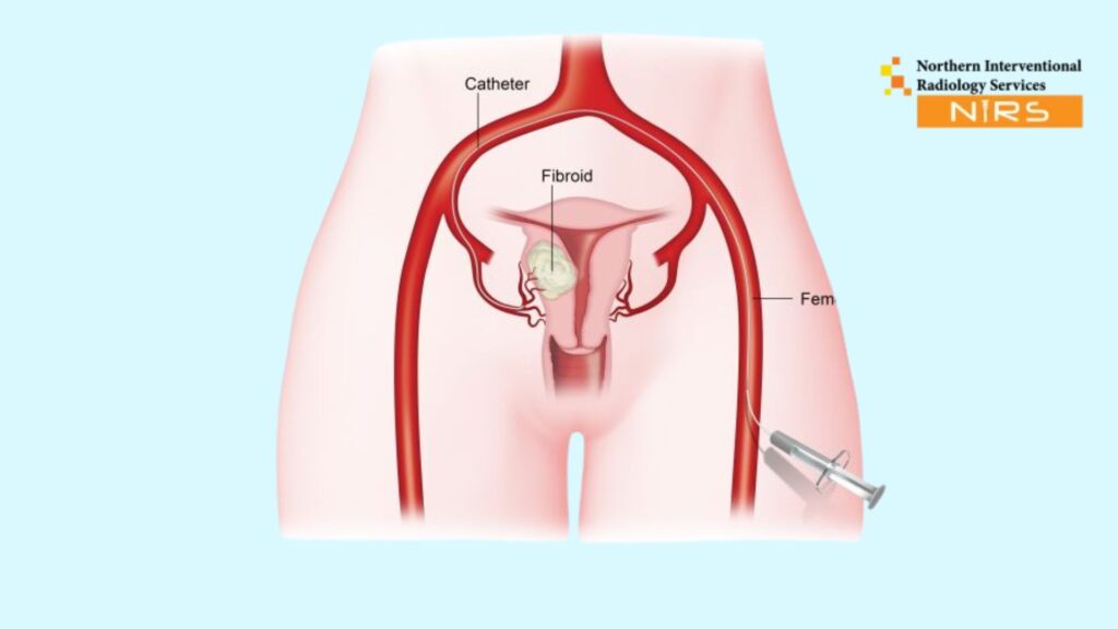 How UFE Uterine Fibroid Embolization Works Benefits Procedure & Recovery at NIRS Northern Interventional Radiology Services Pakistan