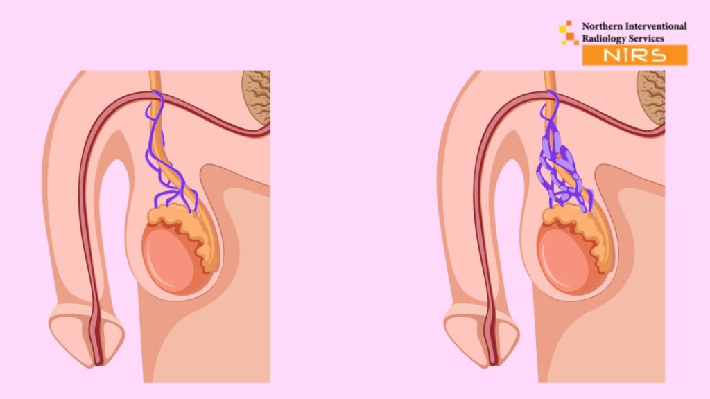 Understanding Male Infertility and Varicocele IR Treatment at NIRS Northern Interventional Radiology Services Pakistan