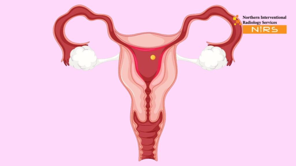 Non-Surgical Treatment for Uterine Adenomyosis in Pakistan at NIRS Northern Interventional Radiology Services Minimally Invasive Care