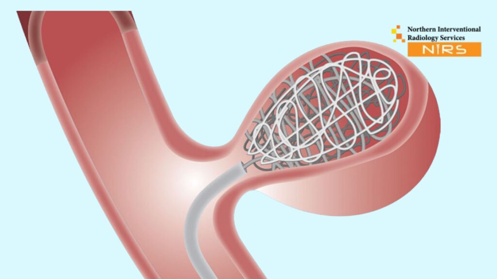 Reasons to Choose Embolization Over Surgery. Embolization procedure at NIRS Pakistan for minimally invasive treatment options including uterine fibroid embolization