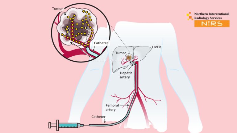 Trusted TACE Treatment in Gujar Khan Rawalpindi at NIRS – advanced interventional radiology and liver cancer procedure with expert IR doctors