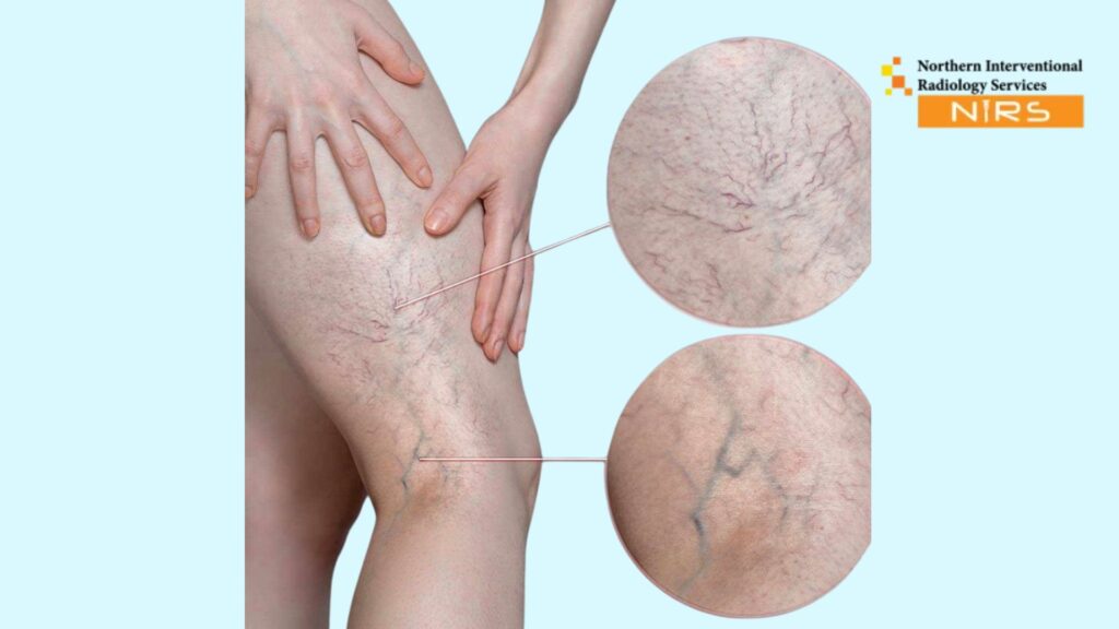 best Varicose Veins Treatment in Rawalpindi and Islamabad using advanced interventional radiology at NIRS Pakistan