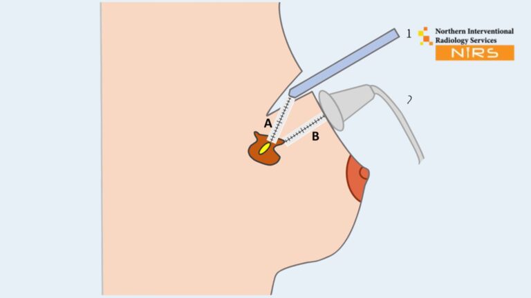 Ultrasound guided breast wire localization placement in Bahria Town Karachi at NIRS – advanced breast imaging in Clifton Karachi