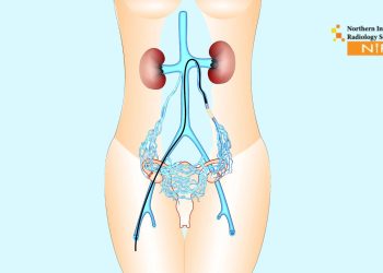 Ovarian Vein Embolization treatment at NIRS Pakistan for pelvic congestion syndrome using advanced interventional radiology