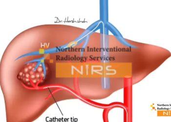 The TACE chemo procedure at NIRS delivers targeted chemotherapy directly to liver tumors using advanced catheter-based techniques for maximum precision and minimal side effects.